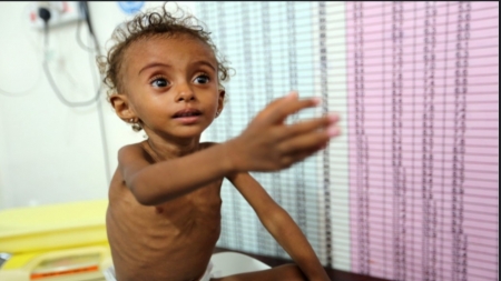 واشنطن: تقرير دولي يتوقع زيادة حالات سوء التغذية الحاد بين الأطفال في اليمن بنسبة 30% هذا العام