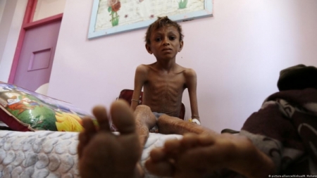 اليمن: تمويل أمريكي إضافي بـ30 مليون دولار لعلاج نصف مليون طفل من سوء التغذية الوخيم