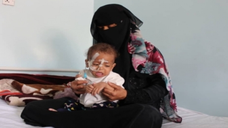 اليمن: ارتفاع "مُقلق" لمعدلات سوء التغذية بين الأطفال ونحو 4 آلاف حالة في خمسة أشهر