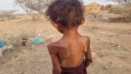 اليمن: وفاة طفلة نازحة في عبس بمحافظة حجة جراء سوء التغذية