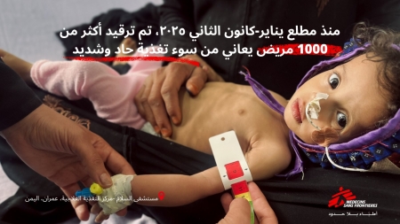 اليمن: ارتفاع معدلات سوء التغذية الحاد في عمران وأكثر من ألف حالة منذ بداية العام