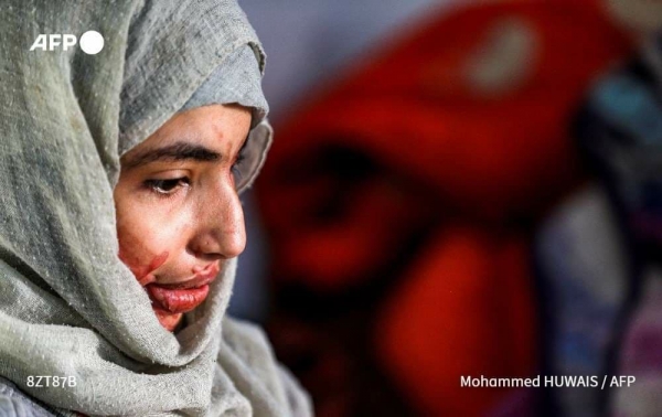 وجه الشابة العنود مرآة لمعاناة نساء اليمن من العنف والزواج المبكر