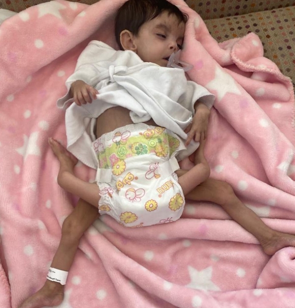 الرياض: طاقم طبي سعودي يجري غدا الخميس عملية فصل توأم طفيلي يمني