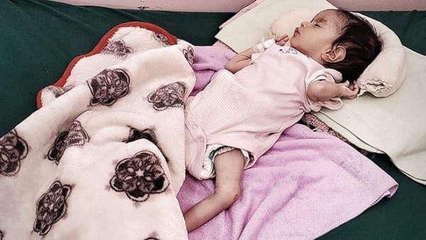 اليمن: الصحة العالمية تقول ان ثلاثة اطفال يمنيين من بين اربعة يعانون سوء التغذية