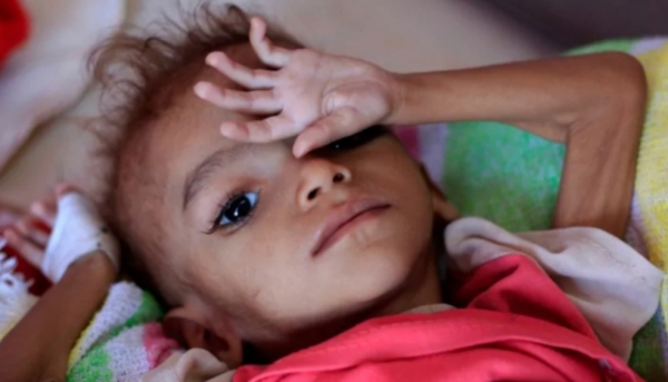 اليمن: الأمم المتحدة تخصص 5.4 مليون دولار لمعالجة سوء التغذية في 5 محافظات