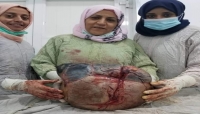 اليمن: فريق طبي ينجح في استئصال ورم وزنه 10 كليو جرامات من مبيض إمرأة في العقد السابع