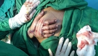 اليمن: فريق جراحي يجري زراعة نادرة لجلد اليد من اوعية البطن