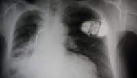 تكنولوجيا: تطوير جهاز تنظيم ضربات القلب خال من البطاريات