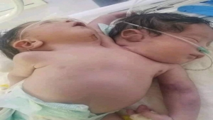 اليمن: ولادة توأم سيامي في صنعاء برأسين وبطنين وستة اطراف