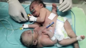 اليمن: ولادة توأم سيامي ملتصق بمنطقة الصدر والبطن في عمران