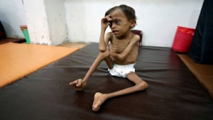 اليمن: 28.9 مليون دولار منحة أمريكية لمكافحة سوء التغذية لدى الأطفال