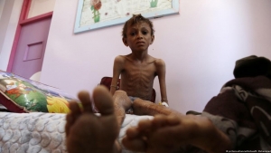 اليمن: تسجيل أكثر من 120 ألف طفل مصاب بسوء التغذية الحاد في النصف الأول من العام الجاري