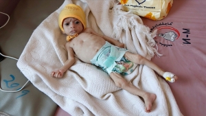 اليمن: فرنسا تدعم "الغذاء العالمي" لتقديم المساعدات الإنسانية وعلاج سوء التغذية لدى الأطفال