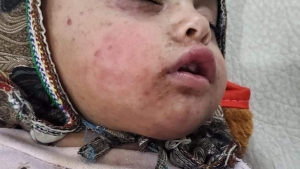 اليمن: 226 إصابة مؤكدة بالحصبة في المحافظات الجنوبية والشرقية