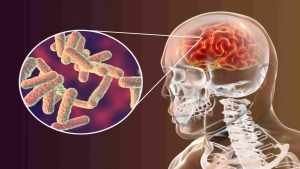 صحة: التهاب السحايا يترك أسوار المخ الثلاثة تحت الهجوم