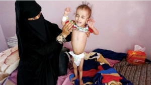 اليمن: 900 حالة إصابة بالحصبة والدفتيريا والسعال الديكي في مناطق سيطرة الحوثيين بمحافظة الضالع