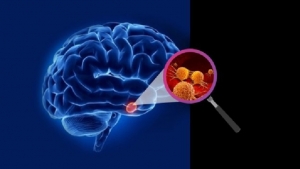 صحة: أعراض تنذر بوجود ورم في المخ