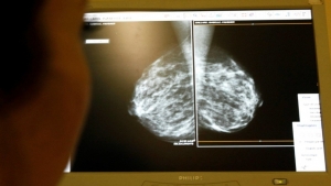 صحة: أعراض شائعة قد تشير لسرطانات تصيب النساء
