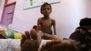 نيويورك: اليمن تتصدر قائمة 17 بلداً تعاني من أعلى مستويات الجوع في العالم
