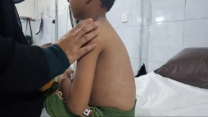 اليمن: أكثر من 1500 إصابة بالحصبة بين الأطفال في مناطق الحوثيين بتعز خلال السبعة الأشهر الأخيرة
