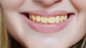 صحة: 3 ممارسات شائعة تؤدي إلى اصفرار أسناننا